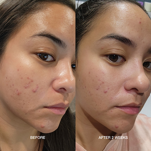 acne before and affter