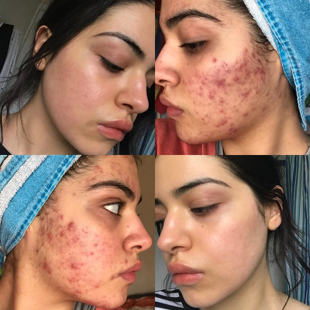 acne before and after