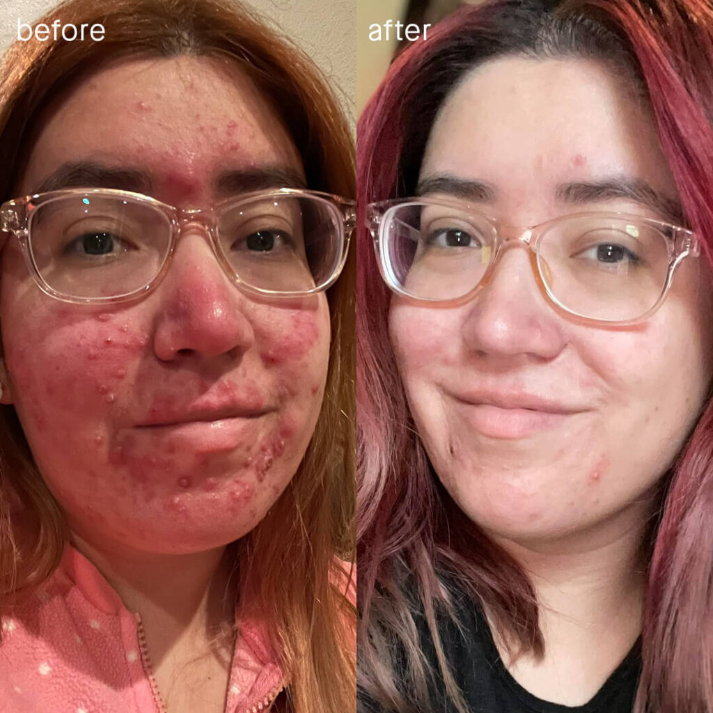 Real Results SLMD Acne System Susana f